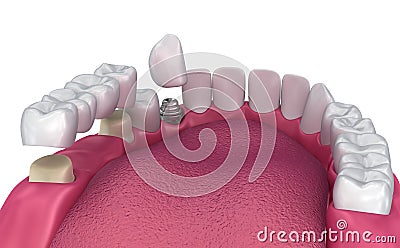 Tooth supported fixed bridge, implant and crown. Medically accurate illustration Cartoon Illustration