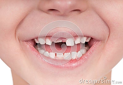 Toothless smile Stock Photo