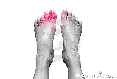 Top view picture of two bare human female feet with a wounded big toe healed with bandage for medical care. Stock Photo