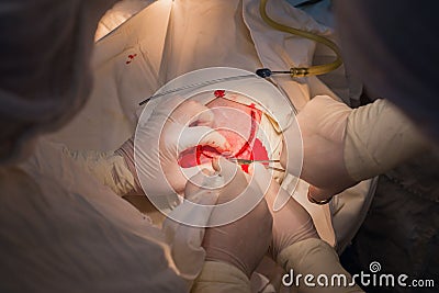 Top view, stages of neurosurgical surgery for installing a titanium plate in the patients skull. Pediatric neurosurgery. Stock Photo