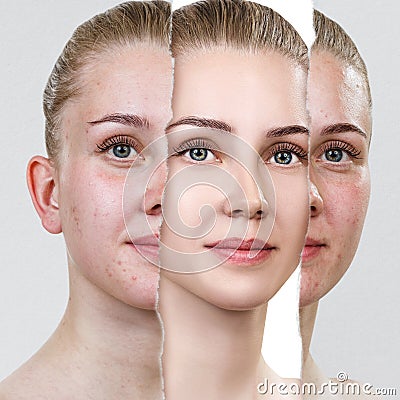 Compare of old photo with acne and new healthy skin. Stock Photo