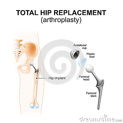 Total hip replacement or arthroplasty. Vector Illustration