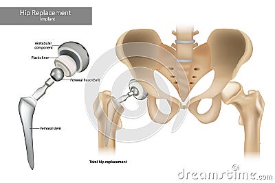 Total hip replacement components. Hip Implant. Vector Illustration