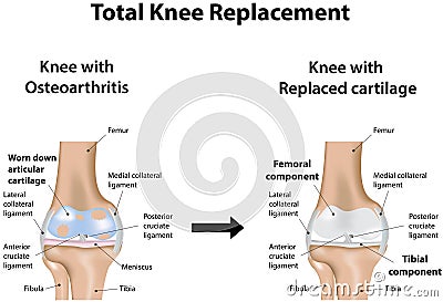 Total Knee Replacement Vector Illustration