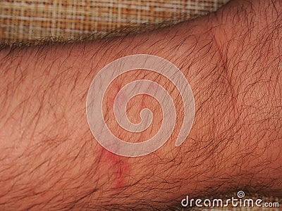 Traces of bites of blood-sucking insects (mosquitoes, horseflies) on human skin Stock Photo