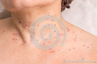 Traces of removal of papillomas on the neck of a woman_ Stock Photo