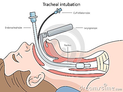 Tracheal intubation diagram medical science Vector Illustration
