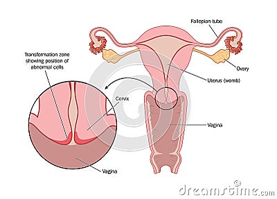 Transformation zone of cervix Vector Illustration