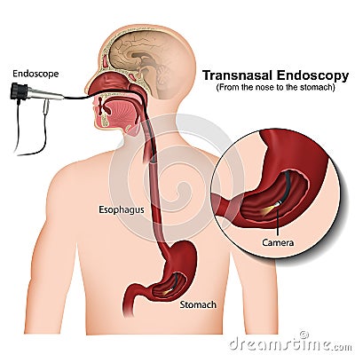 Transnasal endoscopy medical illustration on white background Cartoon Illustration