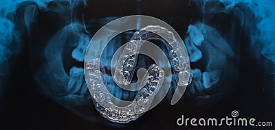 Transparent bite correction trays and x-ray of the jaw. Orthodontist equipment Stock Photo