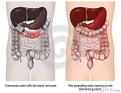 Transverse colectomy 3d medical vector illustration Vector Illustration