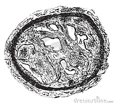 Transverse section of a thrombosed blood vessel in which organization and canalization of the thrombus are in progress, vintage Vector Illustration