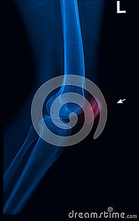 Trauma knee joint x-rays image Stock Photo