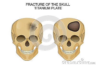 Traumatic brain injury. titanium plate Vector Illustration