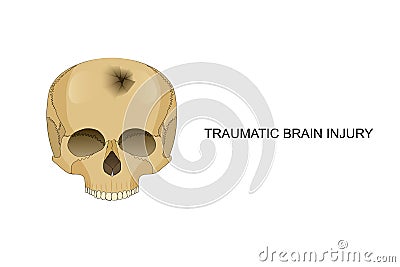 Traumatic brain injury Vector Illustration
