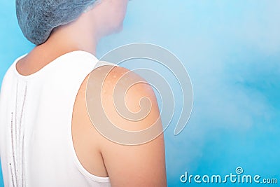 Treatment of age spots on the skin of a girl with the help of a modern method of cryotherapy and ozone therapy. Liquid Stock Photo