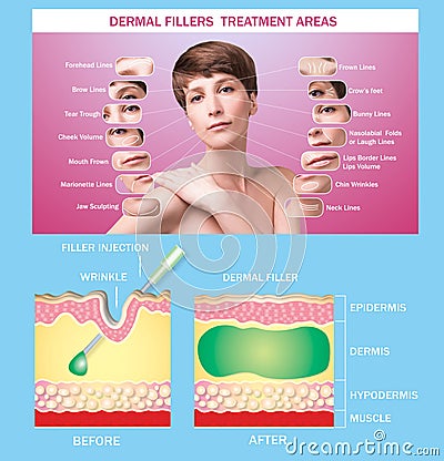 Treatment areas for anti-wrinkle injection. Young female with clean fresh skin. Beautiful woman. Female face and neck Stock Photo