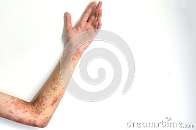 Treatment for atopic dermatitis an infection and itching on a girl arm involves administering medicine Stock Photo