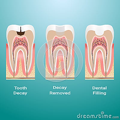 Treatment Of Caries. Dental Filling. Dental Caries Detailed Isolated On A Background. Vector Illustration. Stock Photo