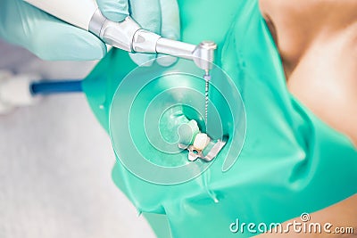 Treatment of dental canals in the bottom molar permanent molar using an apex locator file, a tooth with a clip attached to it with Stock Photo