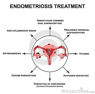 Treatment of endometriosis. Adenomyosis. The structure of the pelvic organs with endometriosis. Infographics. Vector Vector Illustration