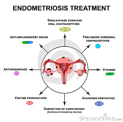 Treatment of endometriosis. Adenomyosis. The structure of the pelvic organs with endometriosis. Infographics. Vector Vector Illustration
