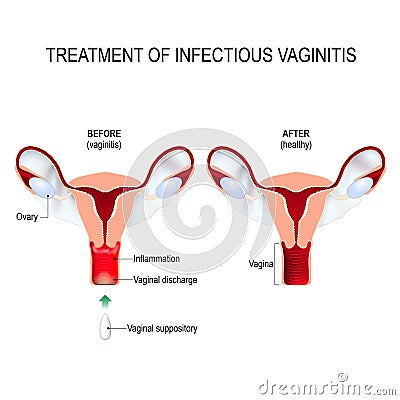 Treatment of infectious vaginitis Vector Illustration