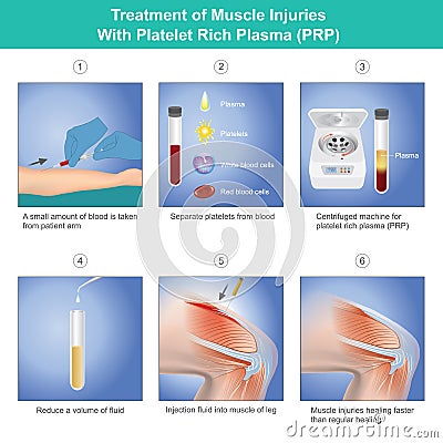 Treatment of Muscle Injuries With Platelet Rich Plasma. Diagram treatment of muscle injuries a knee from blood platelet Vector Illustration