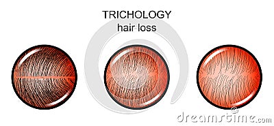 Trichology. hair loss Vector Illustration