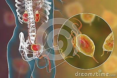 Trichomoniasis infection in man Cartoon Illustration