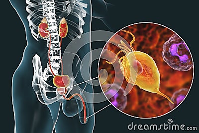 Trichomoniasis infection in man Cartoon Illustration