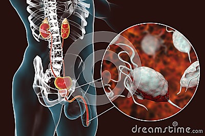 Trichomoniasis infection in man Cartoon Illustration