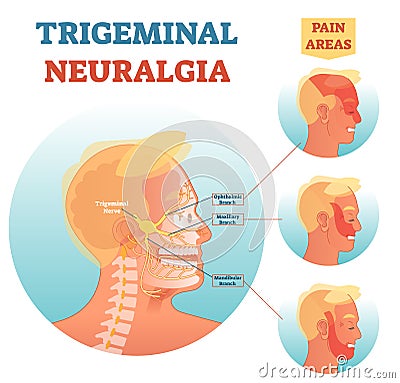 Trigeminal neuralgia medical cross section anatomy vector illustration diagram with facial neural network and pain areas. Vector Illustration