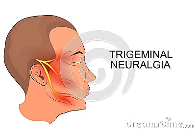 Trigeminal neuralgia. neuroscience Vector Illustration