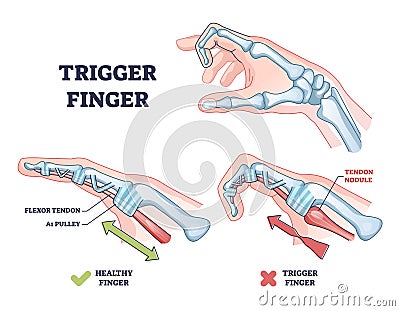 Trigger finger as finger stuck in bent position condition outline diagram Vector Illustration