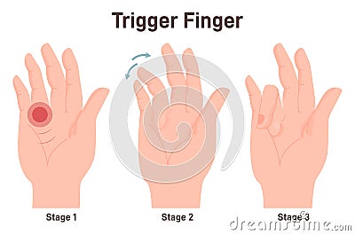 Trigger finger or finger lock. Disease causing pain, stiffness, and a sensation Vector Illustration