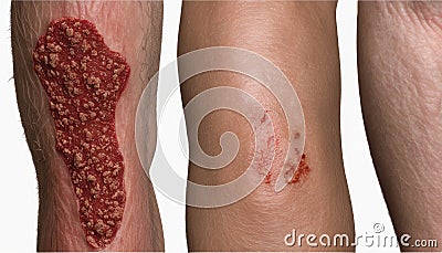 A trio of skin abrasions, each in a different stage of healing Stock Photo