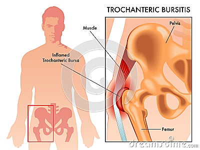 Trochanteric bursitis medical illustration Vector Illustration