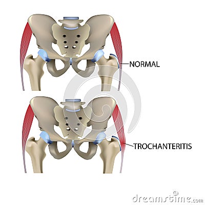 Trochanteritis, femoral tendon inflammation, femoral tendon diseases, vector medical illustration Vector Illustration