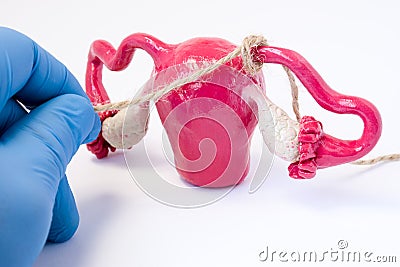 Tubal ligation or surgical procedure tubectomy in operative gynecology concept photo. Doctor binds with rope fallopian tubes model Stock Photo