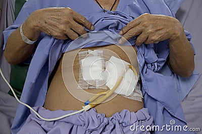 Tube feeding man patient stomach lying on hospital bed Stock Photo