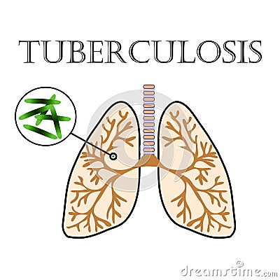 Tuberculosis Bacteria Danger. Infographics Illustration Vector Illustration