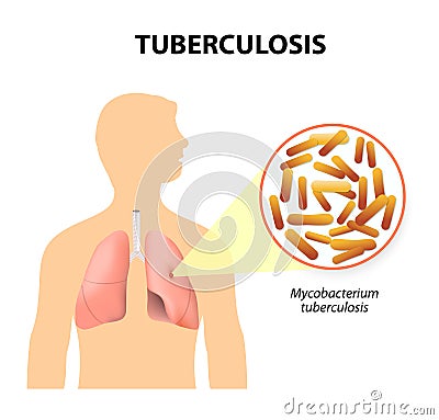 Tuberculosis, MTB or TB Vector Illustration