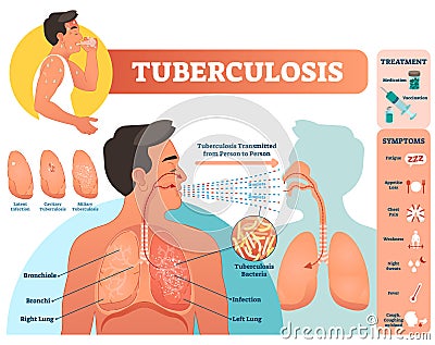 Tuberculosis vector illustration. Detailed symptoms and treatment scheme. Vector Illustration