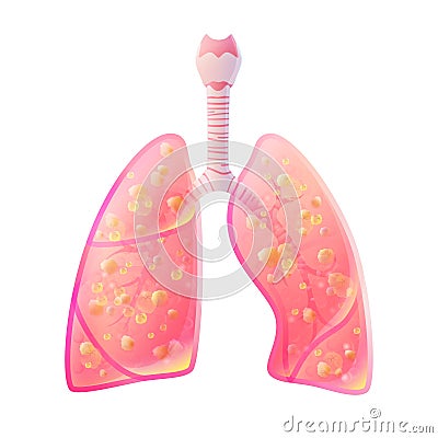 Tuberculosis. Vector illustration of lung Vector Illustration