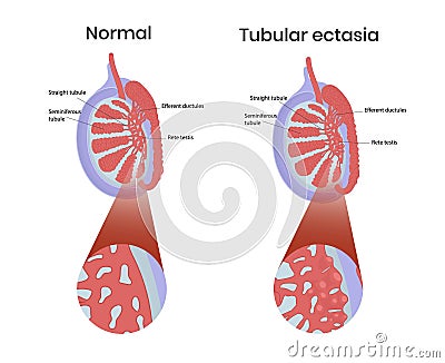 Tubular ectasia of rete testis with normal testicular anatomy Vector Illustration