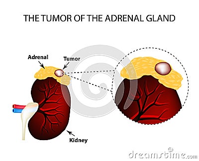 A tumor of the adrenal gland. Structure of the kidneys. Vector illustration on isolated background Vector Illustration