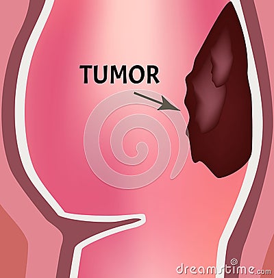 A tumor in the rectum. The structure of the rectum of the intestine. Types of polyps and tumors in the colon Vector Illustration