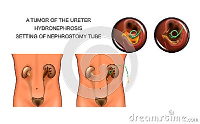 A tumor of the ureter. hydronephrosis. setting of nephrostomy tube Vector Illustration
