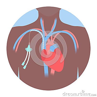 Tunneled central line venous catheter medical diagram Vector Illustration